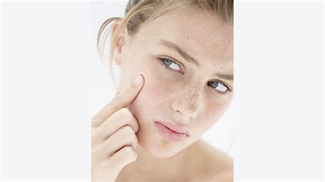 Adult Acne Causes And Treatment Closer