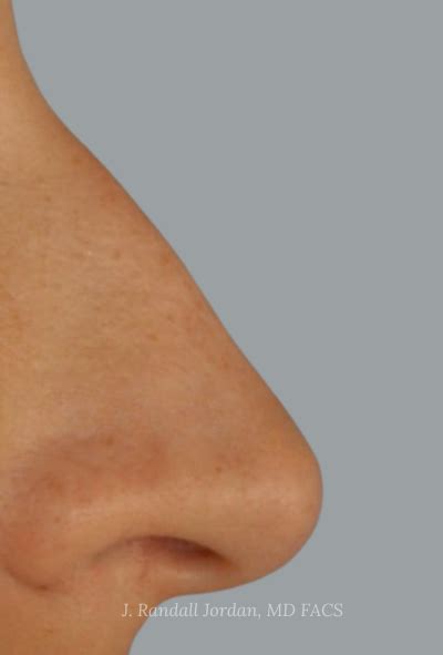 Rhinoplasty Case 2783 Faces PLLC In Ridgeland MS