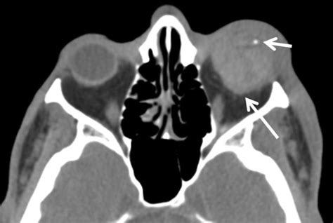 Globe rupture. Axial non-contrast CT image demonstrates... | Download ...