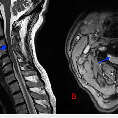 A Preoperative Mri T Sagittal And B T Axial Sequences Blue