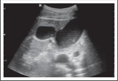 Figure 10 From Sonographic Detection Of A Urinoma Biloma Combination