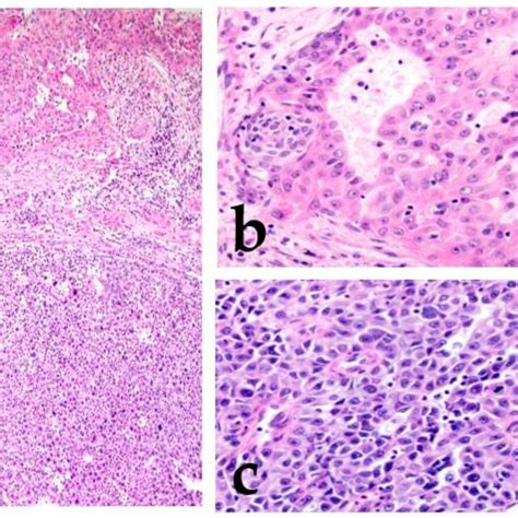 Mucoepidermoid Carcinoma Mec With High Grade Transformation There Is Download Scientific