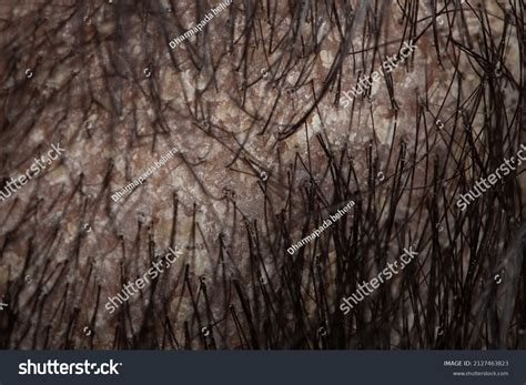 Dry Flaky Scalp Dandruff Problem Psoriasis Stock Photo 2127463823 ...