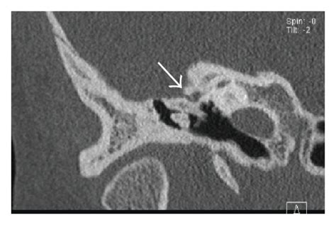 Aural Atresia Axial Ct Images A C Demonstrate Abnormal Facial