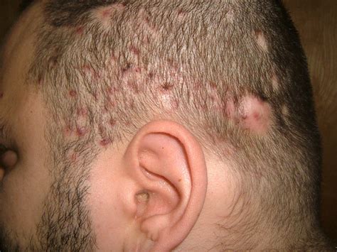 Scalp Cellulitis