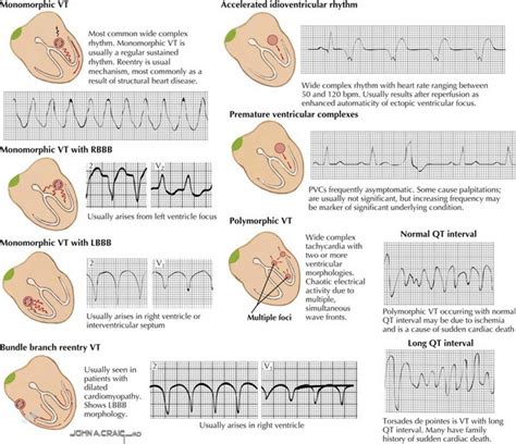 Ventricular Tachycardia | Thoracic Key