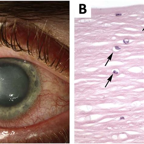 1A: At presentation, exam showed 360° of ciliary flush and a 5 × 6 mm ...