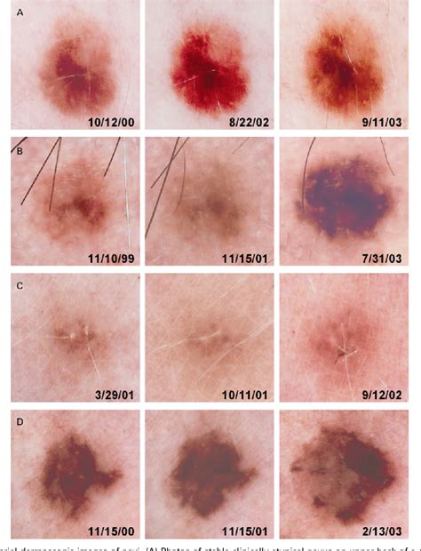 Dysplastic Nevus