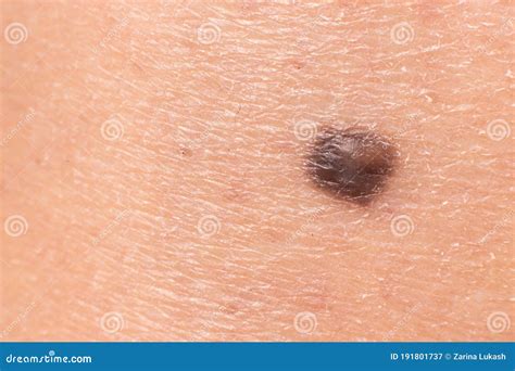 Mole Birthmark Nevus Macro Photo On Human Skin Close Up Stock