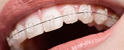 Clear Braces In Logan Providence Ut And Preston Id In Logan