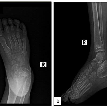 Plain X Ray Radiographs Showing A AP View And B Showing Lateral