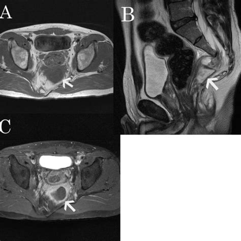 Pdf Currarino Syndrome In An Adult Presenting With A Presacral