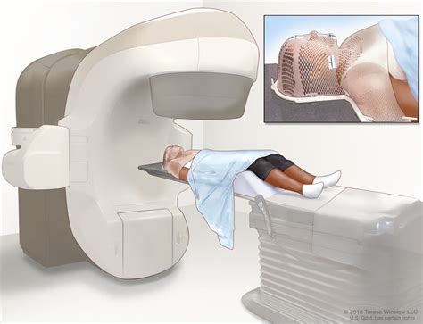 Paranasal Sinus And Nasal Cavity Cancer Treatment Nci