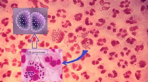 Diagnosis Of Gonorrhea Infection What Are The Available Tests