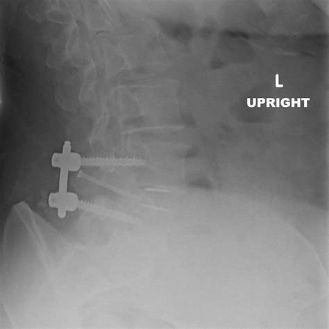 Mel's Ramblings: TLIF Surgery - 6 weeks post-op **Pictures of x-rays