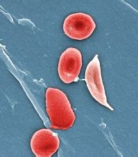 Free picture: patient, sickle, cell, anemia, hbss, blood