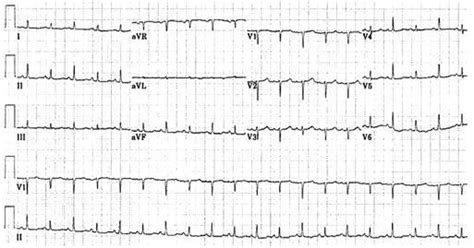 Ekg Findings For Pericardial Effusion Characteristic Ekg Findings For A