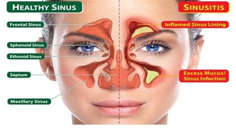 Hidung Mampet Disertai Sakit Kepala Berikut Ini Kemungkinan Penyebab