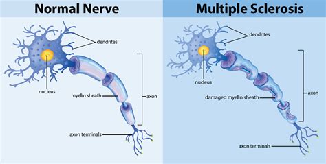 Immune Mediated Disease And Ms National Ms Society