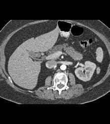 Fatty Infiltration Of The Pancreas Simulates A Mass Pancreas Case