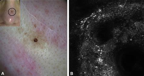 Melanoma Inside Nose