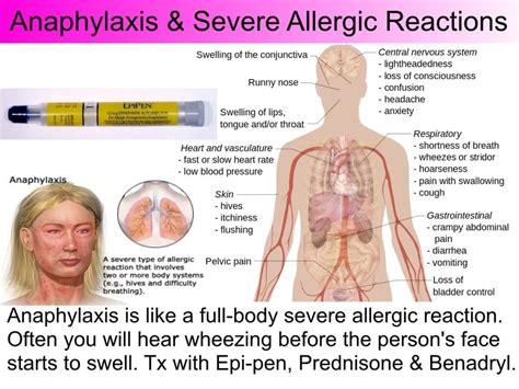 Anaphylactic Shock | In-Pulse CPR