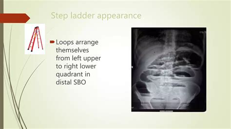 Abdominal X Ray Interpretation Ppt Ppt