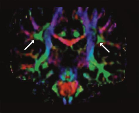 Agenesis Of The Arcuate Fasciculi In Congenital Bilateral Perisylvian