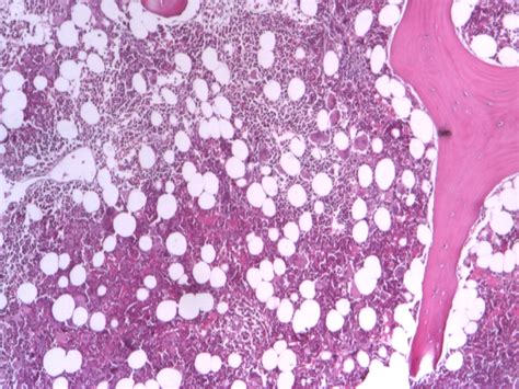 Normocellular Bone Marrow With Increased Number Of Megakaryocytes