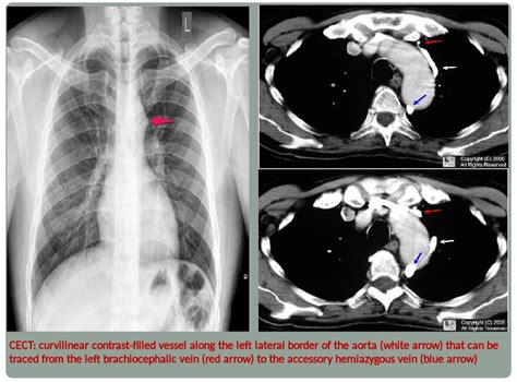 Chest Medicine Made Easy Dr Deepu Aortic Nipple