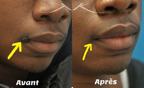 Voici Comment Faire Dispara Tre Les Grains De Beaut Naturellement