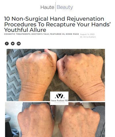 Hand Rejuvenation Media Anna Avaliani MD Cosmetic Laser Surgery