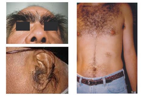 Hypertrichosis Symptoms Causes Treatment And Prevention Richfeel