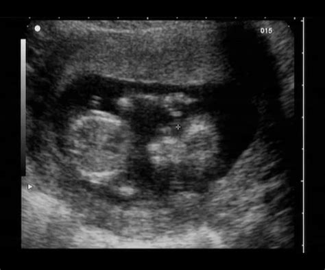 Fetus ultrasound — Stock Photo © Tsekhmister #4594485