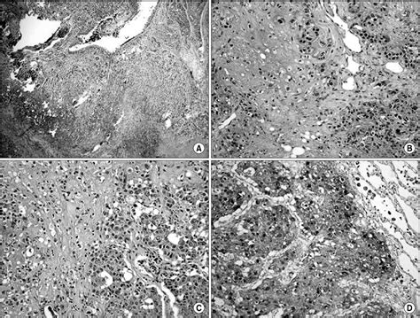 Figure 1 From Primary Pulmonary Carcinoma Ex Pleomorphic Adenoma Of The