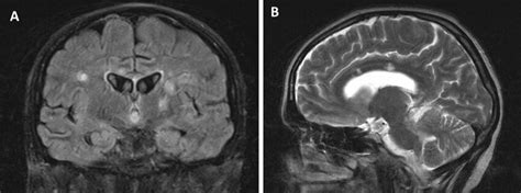 Mri Changes In Susac Syndrome Mri Sequences Of Showing Callosal