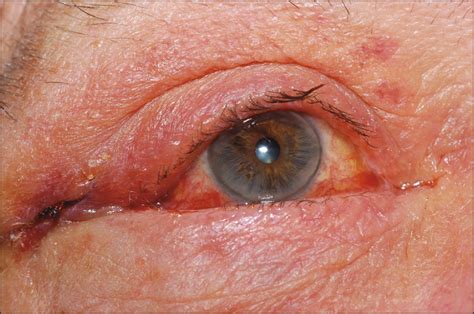 Snip Conjunctivoplasty For Postoperative Conjunctival Chemosis Jama