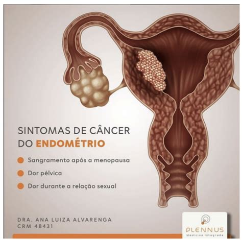 CÂNCER DO ENDOMÉTRIO SINTOMAS Dra Ana Luiza Alvarenga Gomes