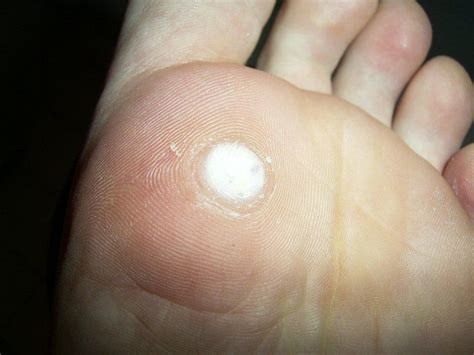 File:Plantar wart after treatment with salicylic acid.jpg - Wikipedia