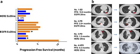 Immune Microenvironment Features And Efficacy Of Pd Pdl Blockade In