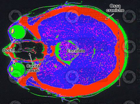 Uomo Encefalo RMN Uomo Mammiferi Sistema Nervoso Altri