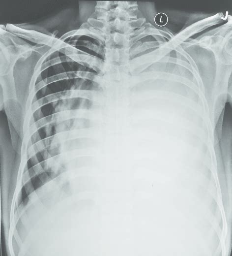 Chest Radiograph Postero Anterior View Showing Massive Left Sided