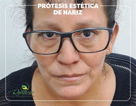 Pr Tesis Est Tica De Nariz Protesis Renacer Protesis Renacer