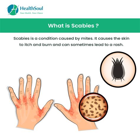 Scabies Causes Transmission Symptoms Diagnosis Treatment And | Images ...