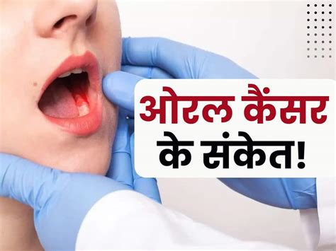 Early Signs Of Oral Cancer दांतों में दर्द और मसूड़ों से खून आना ओरल