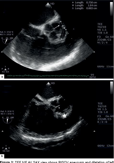 Figure 2 From Transesophageal Echocardiography In Surgical Management