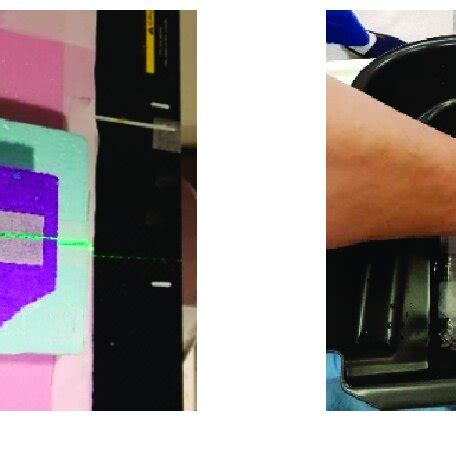 Fabricated bolus and patient set up for radiation therapy: (a) 3D bolus... | Download Scientific ...