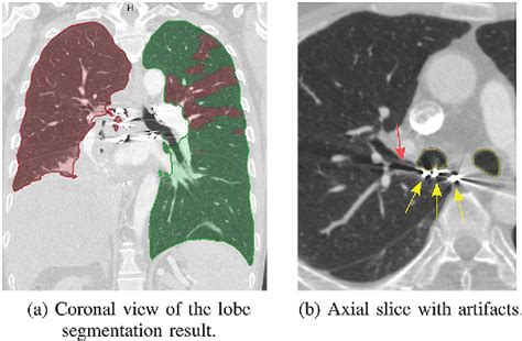 Figure From Automatic Segmentation Of The Pulmonary Lobes From Chest