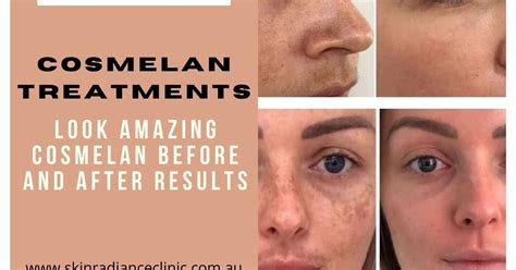 How Does The Cosmelan Peel Treatment Work