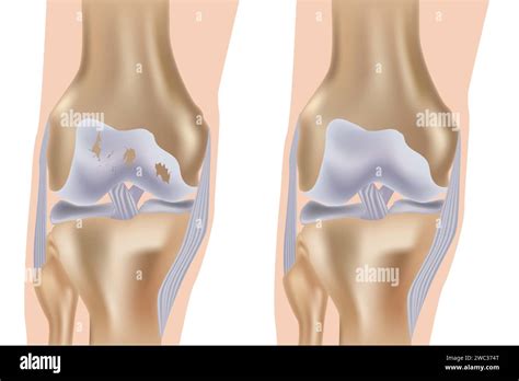 Medical Vector Illustration With Damaged Knee Structure And Healthy